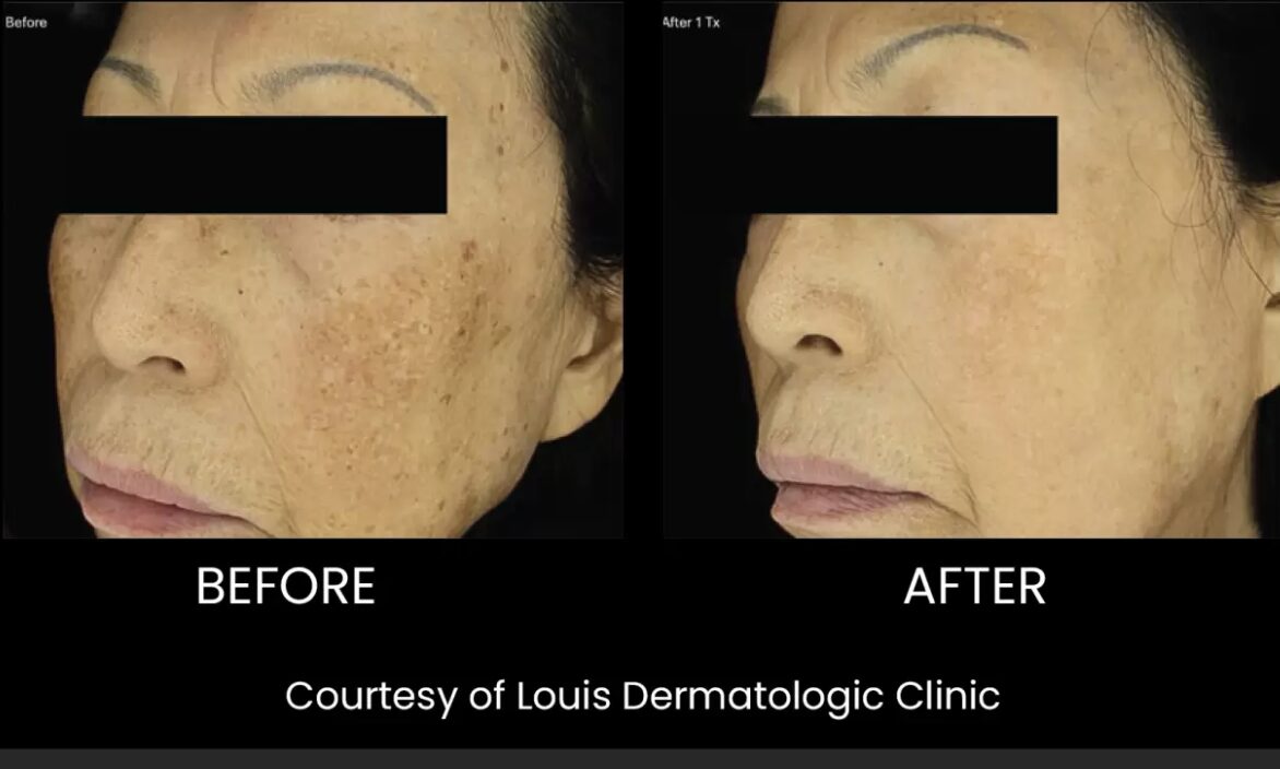 Nouvaderm for hyperpigmentation and texture